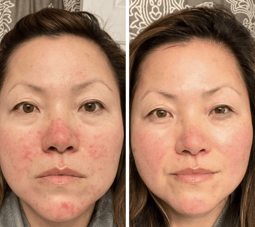 Maska Prestige DermaLight